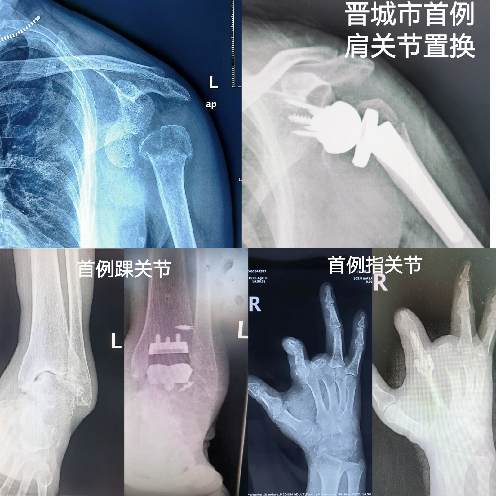 首例關節(jié)置換.jpg